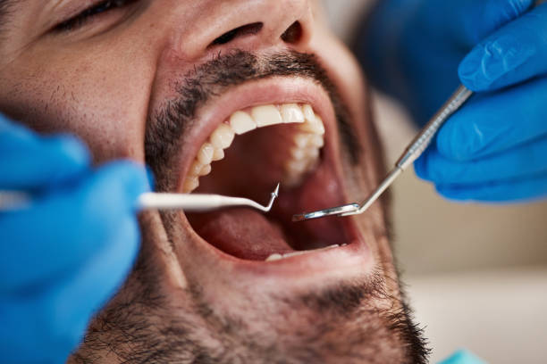 Best Emergency Wisdom Tooth Extraction in Atkins, IA